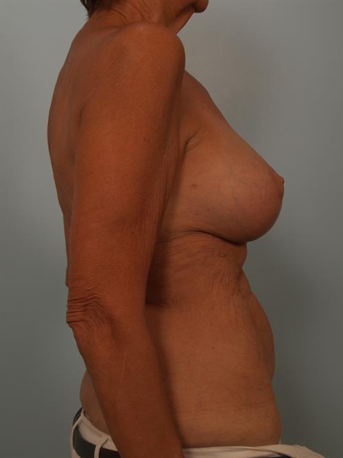 Revision Breast Surgery After Photo | Phoenix and Scottsdale, AZ | Scottsdale Center for Plastic Surgery