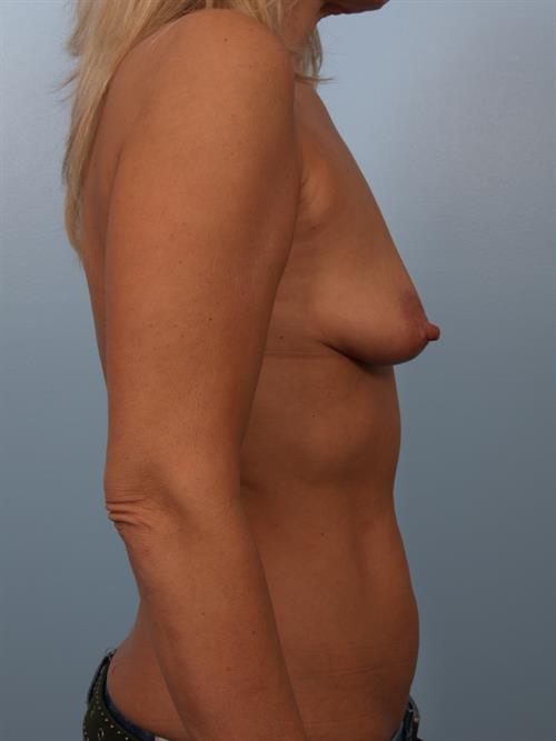 Breast Lift (Mastopexy) Before Photo | Phoenix and Scottsdale, AZ | Scottsdale Center for Plastic Surgery