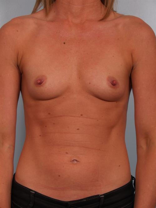 Breast Lift (Mastopexy) Before Photo | Phoenix and Scottsdale, AZ | Scottsdale Center for Plastic Surgery