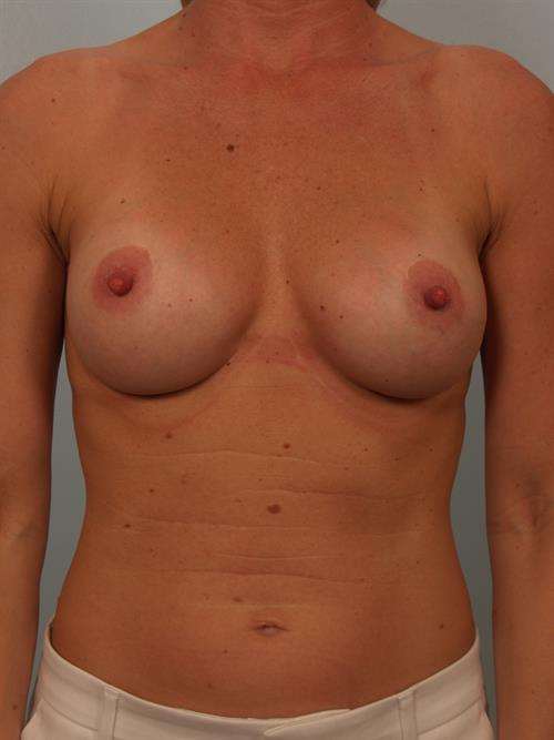 Breast Lift (Mastopexy) After Photo | Phoenix and Scottsdale, AZ | Scottsdale Center for Plastic Surgery
