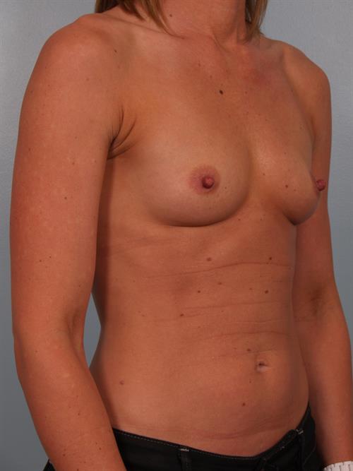 Breast Lift (Mastopexy) Before Photo | Phoenix and Scottsdale, AZ | Scottsdale Center for Plastic Surgery