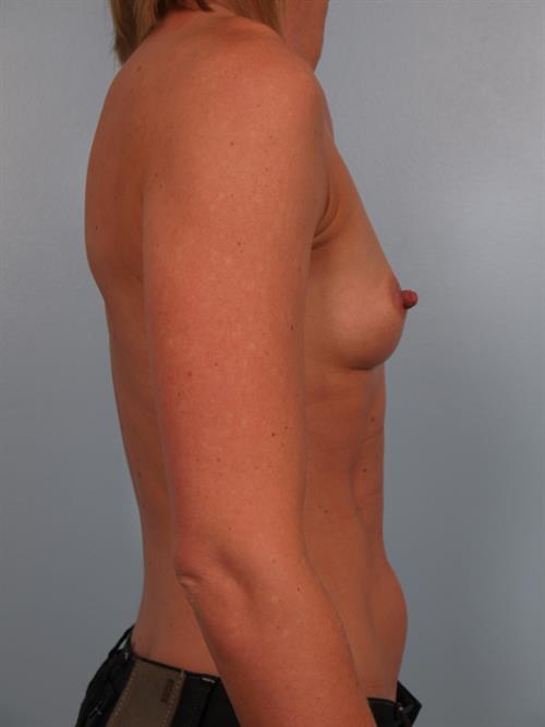 Breast Lift (Mastopexy) Before Photo | Phoenix and Scottsdale, AZ | Scottsdale Center for Plastic Surgery