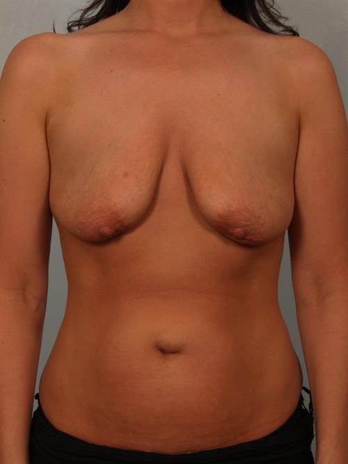 Breast Augmentation Before Photo | Phoenix and Scottsdale, AZ | Scottsdale Center for Plastic Surgery