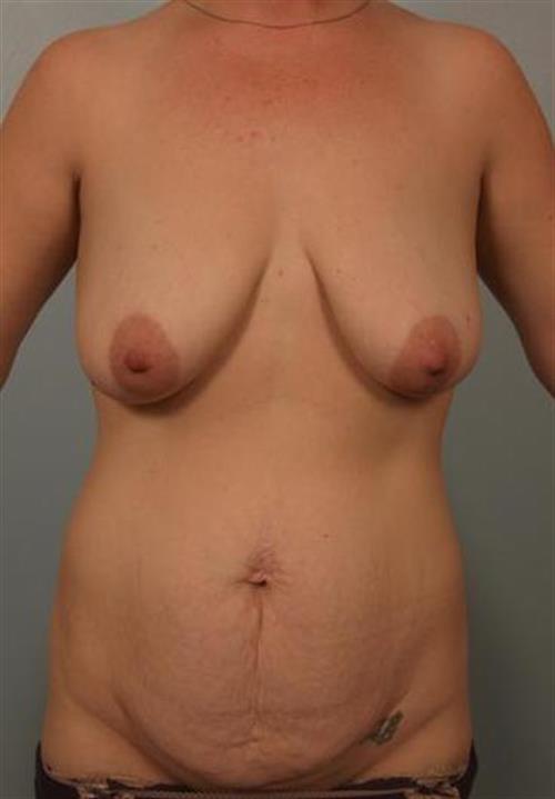Power Assisted Liposuction Before Photo | Phoenix and Scottsdale, AZ | Scottsdale Center for Plastic Surgery