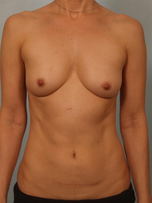 Breast Lift (Mastopexy) Before Photo | Phoenix and Scottsdale, AZ | Scottsdale Center for Plastic Surgery
