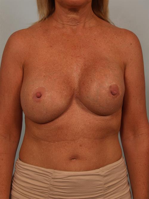 Revision Breast Surgery Before Photo | Phoenix and Scottsdale, AZ | Scottsdale Center for Plastic Surgery