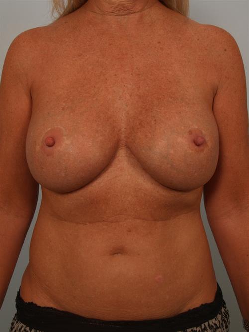 Revision Breast Surgery After Photo | Phoenix and Scottsdale, AZ | Scottsdale Center for Plastic Surgery