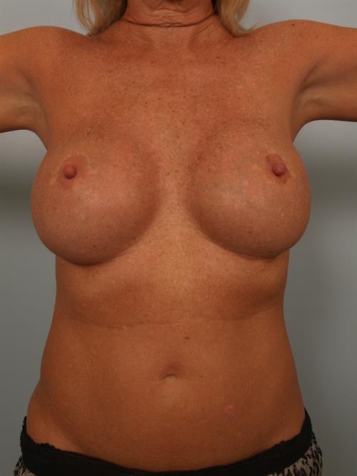 Revision Breast Surgery After Photo | Phoenix and Scottsdale, AZ | Scottsdale Center for Plastic Surgery