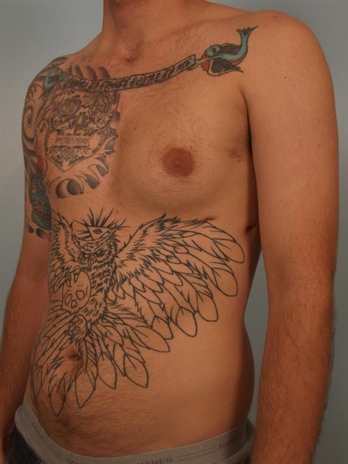 Male Breast/Areola Reduction Before Photo | Phoenix and Scottsdale, AZ | Scottsdale Center for Plastic Surgery