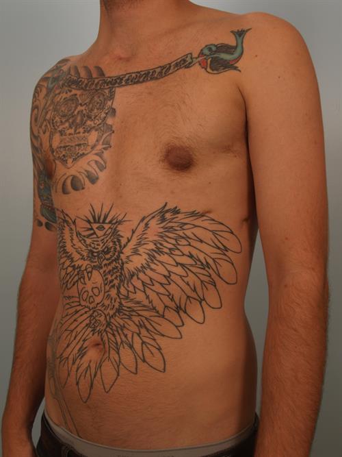 Male Breast/Areola Reduction After Photo | Phoenix and Scottsdale, AZ | Scottsdale Center for Plastic Surgery