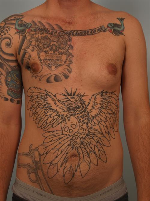 Male Breast/Areola Reduction Before Photo | Phoenix and Scottsdale, AZ | Scottsdale Center for Plastic Surgery