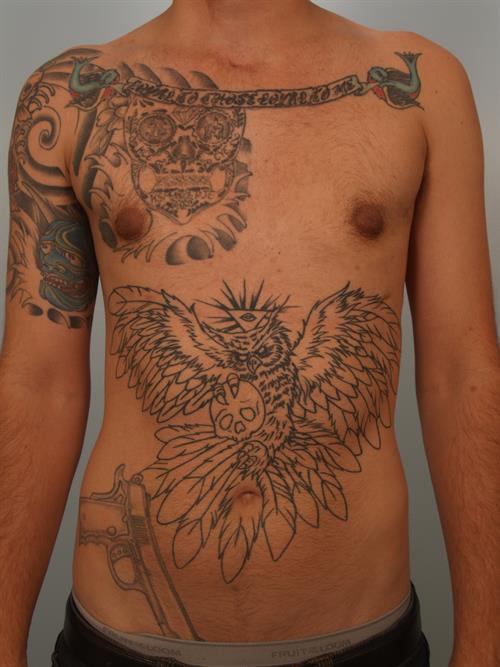Male Breast/Areola Reduction After Photo | Phoenix and Scottsdale, AZ | Scottsdale Center for Plastic Surgery