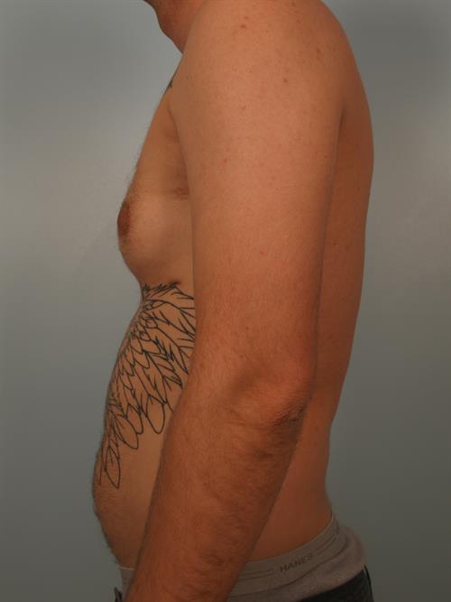 Male Breast/Areola Reduction Before Photo | Phoenix and Scottsdale, AZ | Scottsdale Center for Plastic Surgery