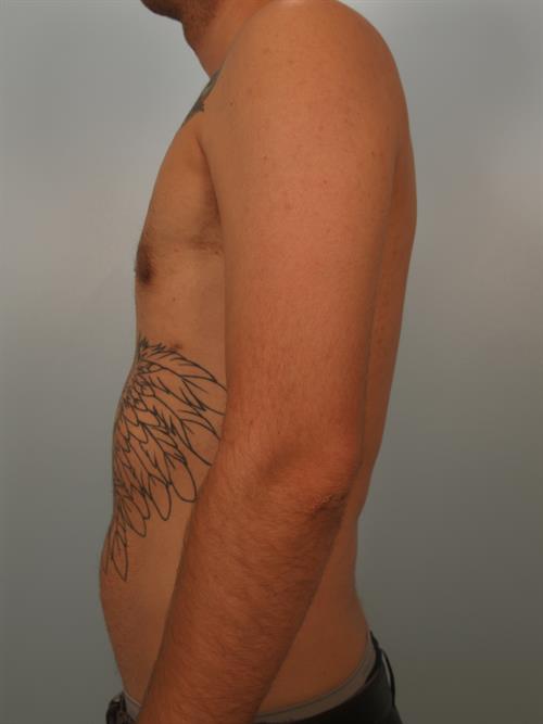Male Breast/Areola Reduction After Photo | Phoenix and Scottsdale, AZ | Scottsdale Center for Plastic Surgery