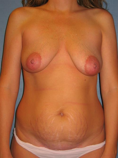 Tummy Tuck Before Photo | Phoenix and Scottsdale, AZ | Scottsdale Center for Plastic Surgery
