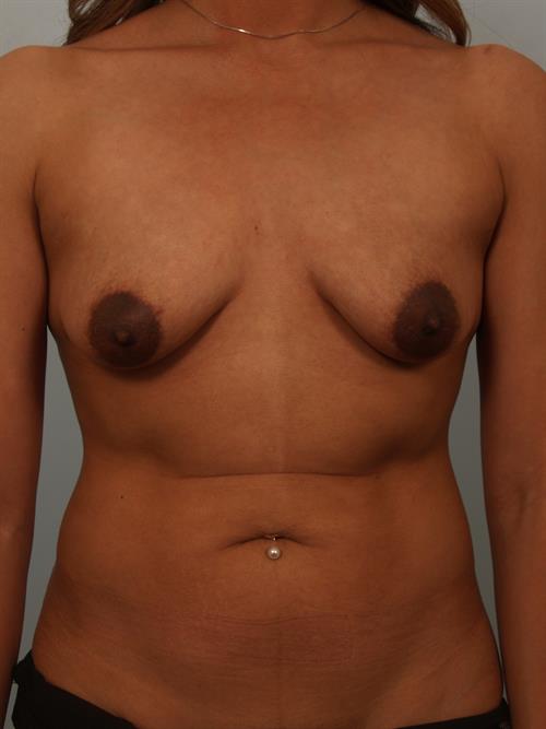 Breast Augmentation Before Photo | Paradise Valley, AZ | Scottsdale Center for Plastic Surgery