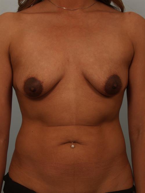 Breast Lift (Mastopexy) Before Photo | ,  | 