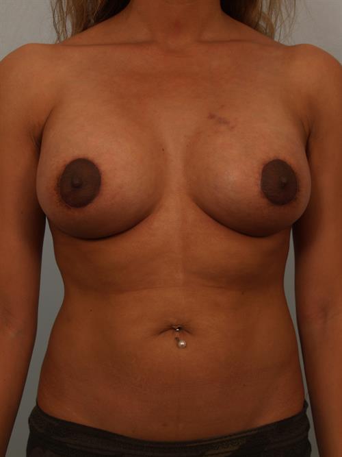 Breast Augmentation After Photo | Paradise Valley, AZ | Scottsdale Center for Plastic Surgery