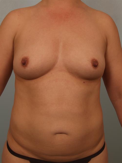 Breast Augmentation Before Photo | Phoenix and Scottsdale, AZ | Scottsdale Center for Plastic Surgery