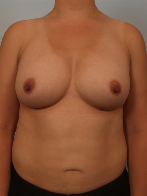 Breast Augmentation After Photo | Phoenix and Scottsdale, AZ | Scottsdale Center for Plastic Surgery