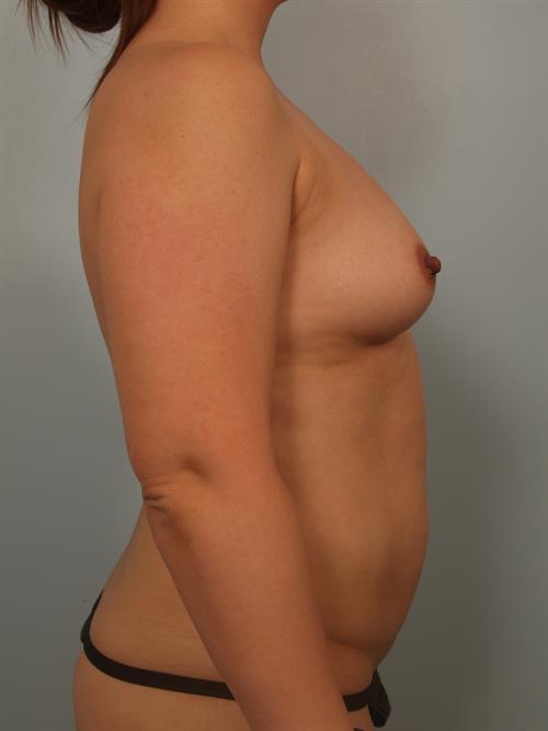Breast Augmentation Before Photo | Phoenix and Scottsdale, AZ | Scottsdale Center for Plastic Surgery