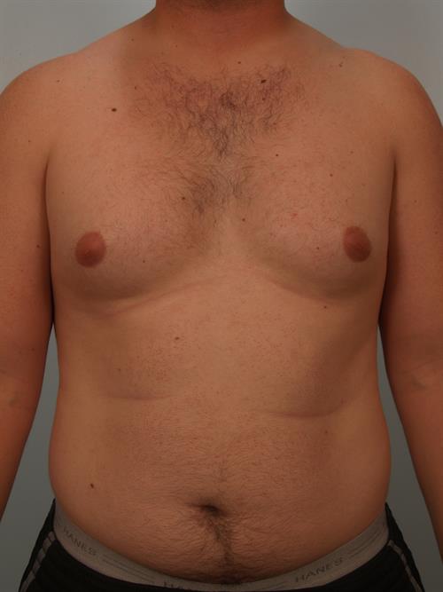 Male Breast/Areola Reduction Before Photo | Phoenix and Scottsdale, AZ | Scottsdale Center for Plastic Surgery