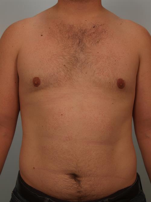Male Breast/Areola Reduction After Photo | Phoenix and Scottsdale, AZ | Scottsdale Center for Plastic Surgery