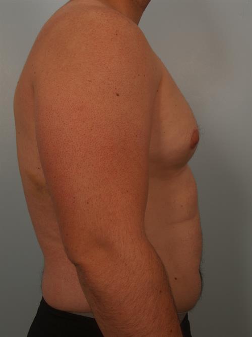 Male Breast/Areola Reduction Before Photo | Phoenix and Scottsdale, AZ | Scottsdale Center for Plastic Surgery