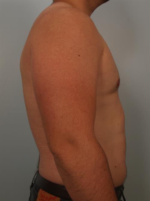 Male Breast/Areola Reduction After Photo | Phoenix and Scottsdale, AZ | Scottsdale Center for Plastic Surgery