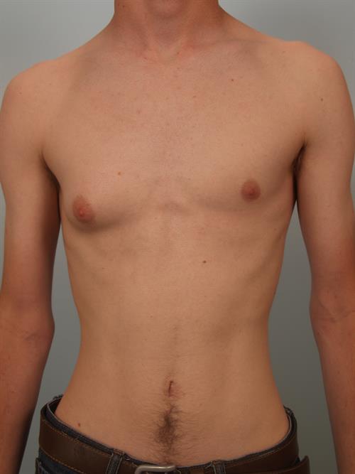Male Breast/Areola Reduction Before Photo | Phoenix and Scottsdale, AZ | Scottsdale Center for Plastic Surgery