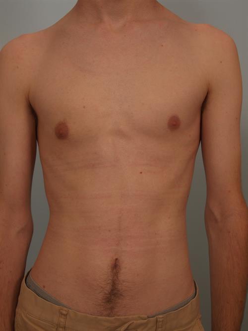 Male Breast/Areola Reduction After Photo | Phoenix and Scottsdale, AZ | Scottsdale Center for Plastic Surgery