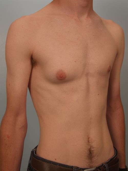 Male Breast/Areola Reduction Before Photo | ,  | 