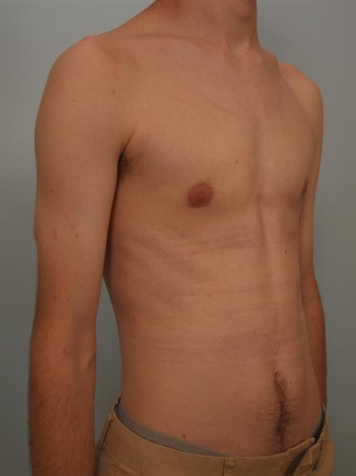 Male Breast/Areola Reduction After Photo | Phoenix and Scottsdale, AZ | Scottsdale Center for Plastic Surgery