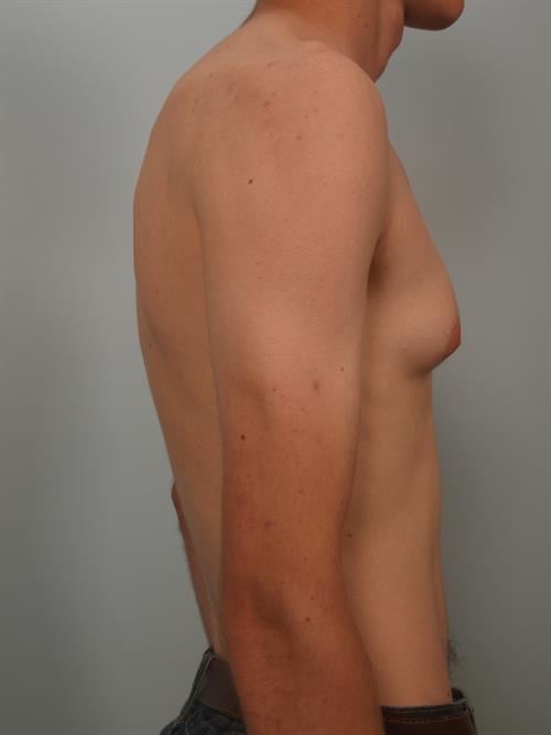 Male Breast/Areola Reduction Before Photo | Phoenix and Scottsdale, AZ | Scottsdale Center for Plastic Surgery