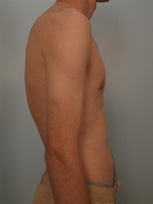Male Breast/Areola Reduction After Photo | Phoenix and Scottsdale, AZ | Scottsdale Center for Plastic Surgery