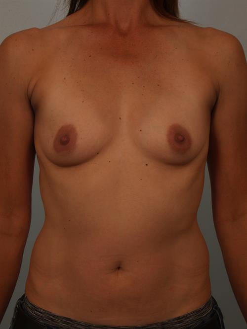 Breast Augmentation Before Photo | Phoenix and Scottsdale, AZ | Scottsdale Center for Plastic Surgery