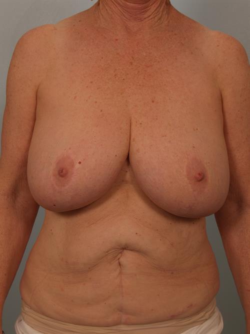 Breast Reduction Before Photo | Phoenix and Scottsdale, AZ | Scottsdale Center for Plastic Surgery