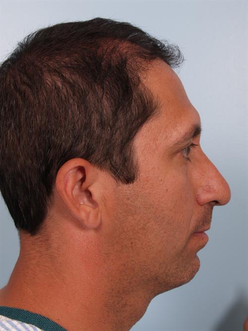 Chin Augmentation Before Photo | Phoenix and Scottsdale, AZ | Scottsdale Center for Plastic Surgery