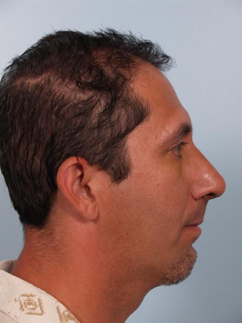 Chin Augmentation After Photo | Phoenix and Scottsdale, AZ | Scottsdale Center for Plastic Surgery