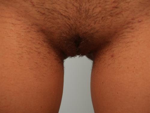 Labia Reduction After Photo | Phoenix and Scottsdale, AZ | Scottsdale Center for Plastic Surgery