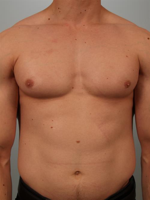 Male Breast/Areola Reduction Before Photo | Phoenix and Scottsdale, AZ | Scottsdale Center for Plastic Surgery