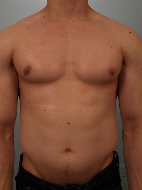 Male Breast/Areola Reduction After Photo | Phoenix and Scottsdale, AZ | Scottsdale Center for Plastic Surgery