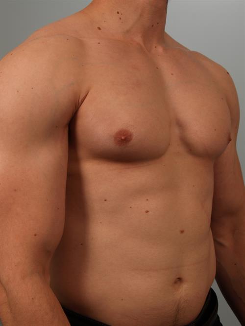 Male Breast/Areola Reduction Before Photo | Phoenix and Scottsdale, AZ | Scottsdale Center for Plastic Surgery