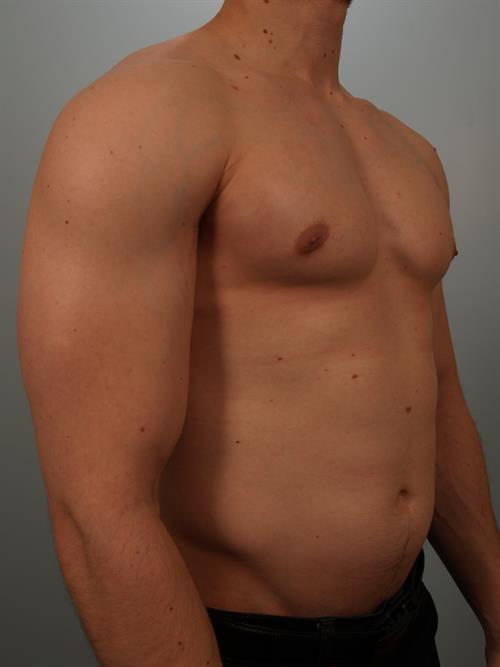 Male Breast/Areola Reduction After Photo | Phoenix and Scottsdale, AZ | Scottsdale Center for Plastic Surgery
