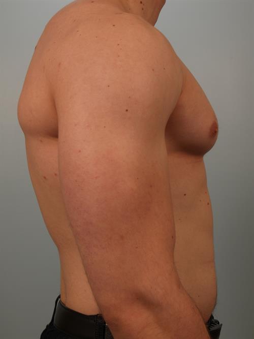 Male Breast/Areola Reduction Before Photo | Phoenix and Scottsdale, AZ | Scottsdale Center for Plastic Surgery