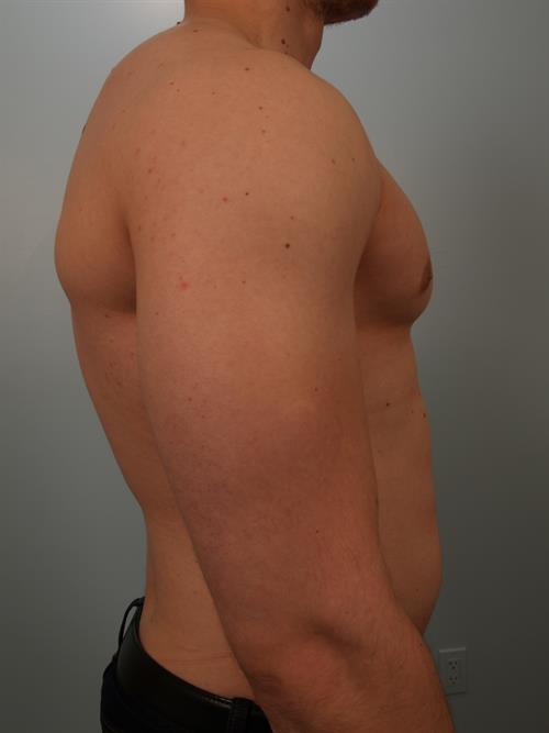 Male Breast/Areola Reduction After Photo | Phoenix and Scottsdale, AZ | Scottsdale Center for Plastic Surgery