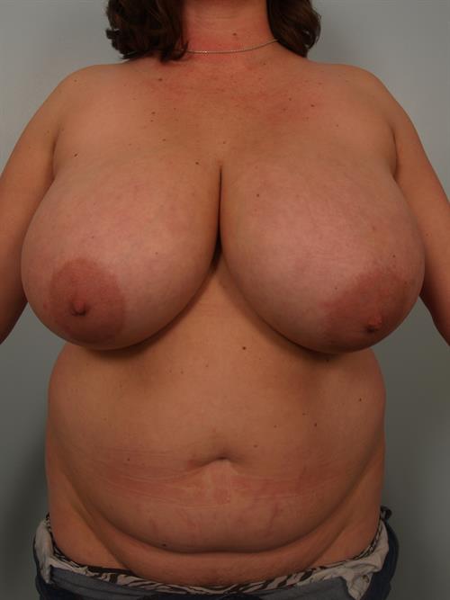 Breast Reduction Before Photo | Phoenix and Scottsdale, AZ | Scottsdale Center for Plastic Surgery
