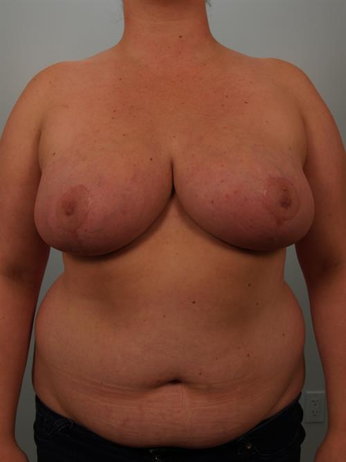 Breast Reduction After Photo | Phoenix and Scottsdale, AZ | Scottsdale Center for Plastic Surgery