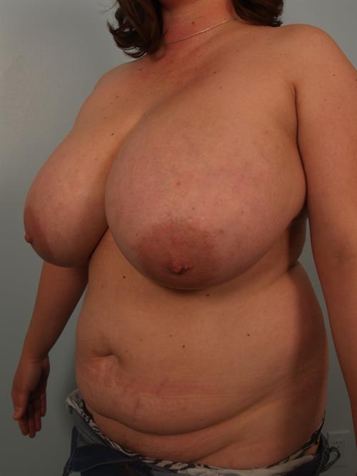 Breast Reduction Before Photo | Phoenix and Scottsdale, AZ | Scottsdale Center for Plastic Surgery