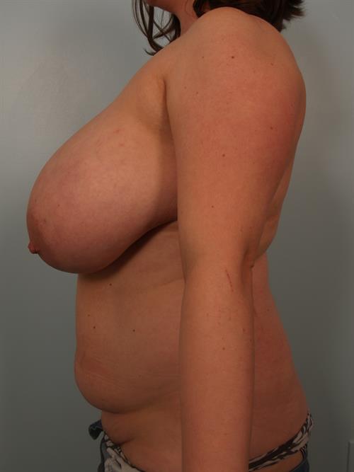Breast Reduction Before Photo | Phoenix and Scottsdale, AZ | Scottsdale Center for Plastic Surgery